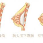 隆胸假体置人不同层次的优缺点比较