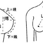 变性隆胸手术的5大黄金线